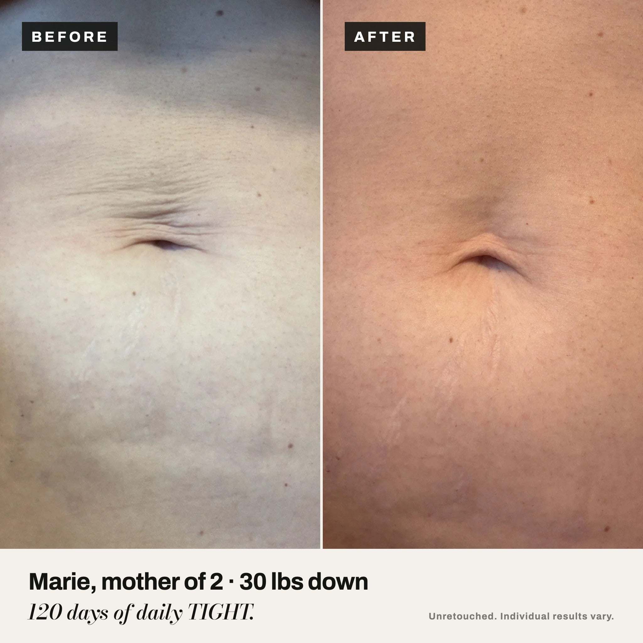 Before and after: Marie, mother of 2, after 120 days of daily TIGHT